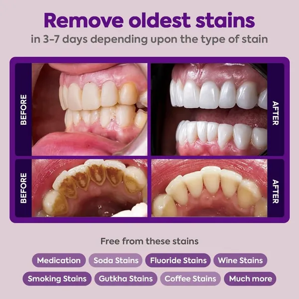 Edith_Naturals_Teeth_Whitening_Powder_Removes_Oldest_Stains_Tartar_Plaque_Cavity_Protection_Enamel_Safe_Natural_Mint_Formula_For_Long_Lasting_Freshness_Men_Women_100_Gm_-_Pack_Of_3