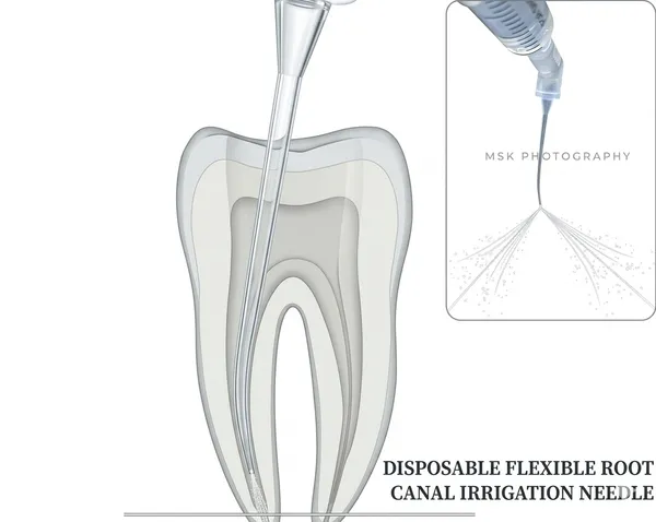 Endo_Twin_Dual_Side-vent_Irrigation_Needle