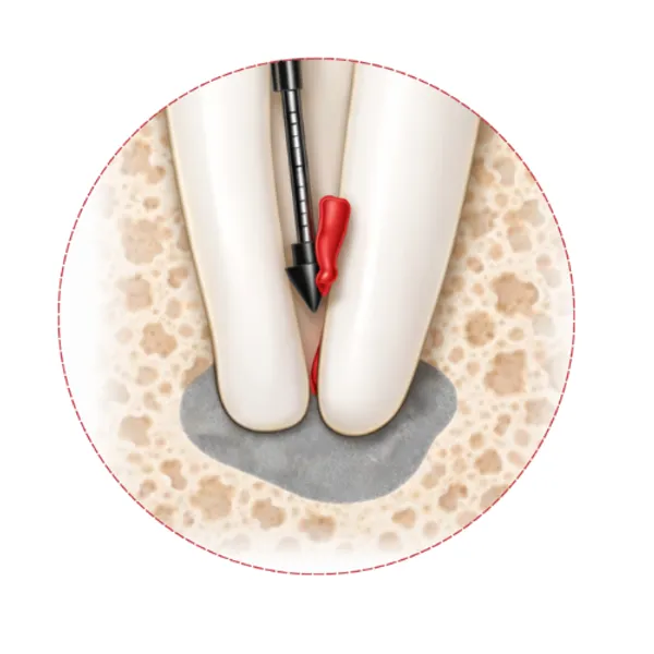 Gp_Spikes_Gutta_Percha_Remover_Endodontic