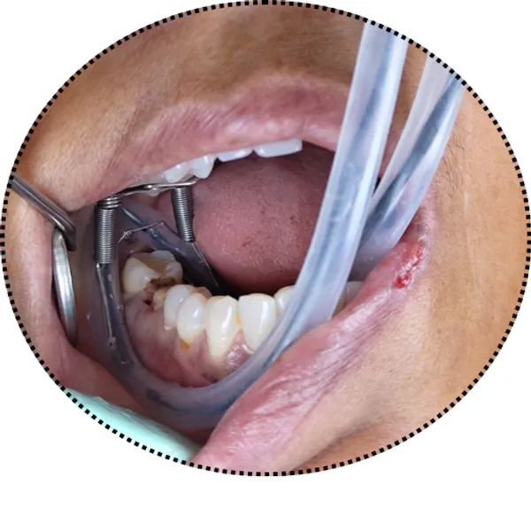 Retra-Vac_Multi-Functional_Salivary_Suction_Tube_Dental