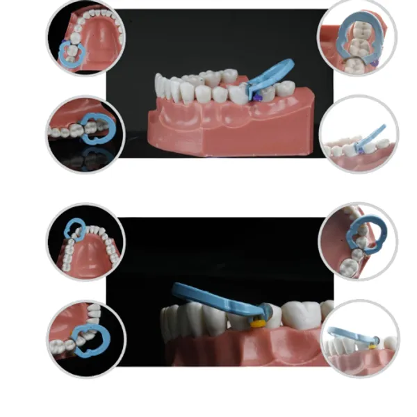 Younitrix_Dental_Matrix_Ring_Restorative_Contouring_Tool