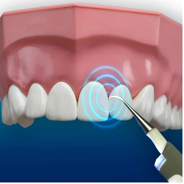 Proroop_Sonic_Vibration_Electric_Teeth_Polishing_Stain_Eraser_Kit