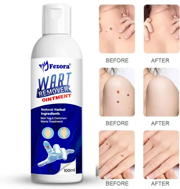 Jezora_Wart_Remover_Ointment