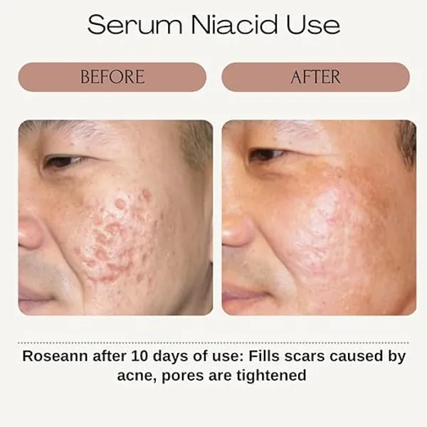 Niacid_Face_Serum