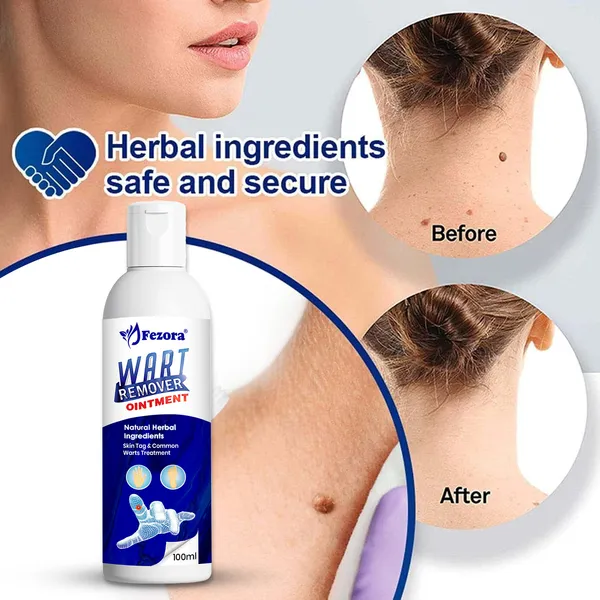 Jezora_Wart_Remover_Ointment