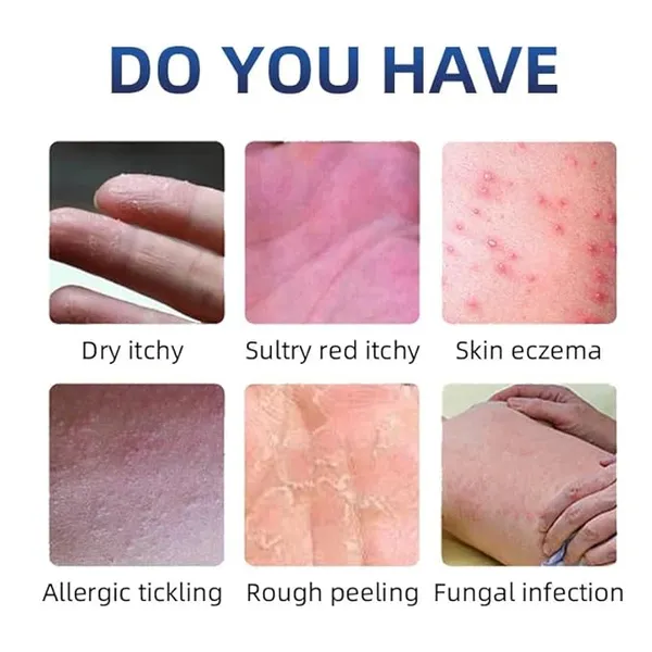 Eczemaron_Psoriasis_Moisturizing_Cream