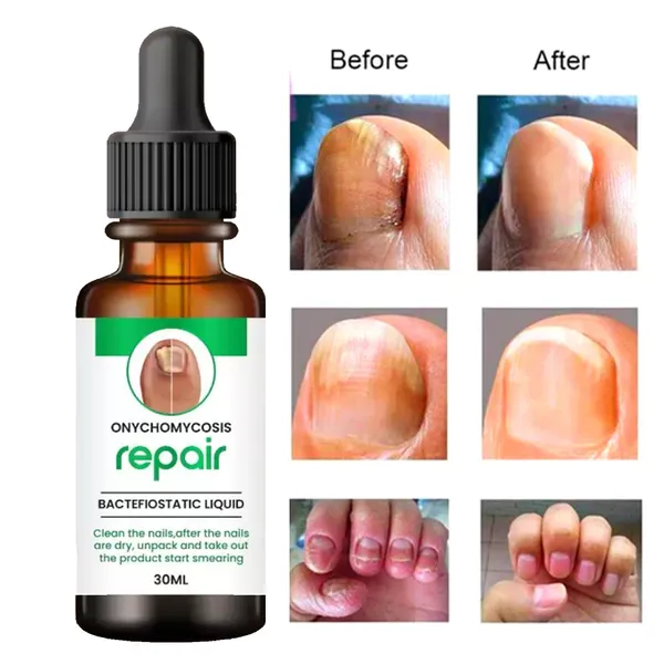 Onychomycosis_Repair_Nail_Treatment_Liquid_30ml