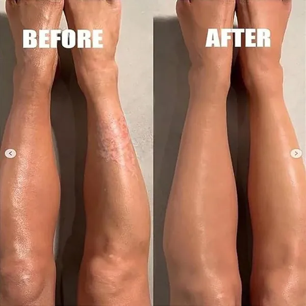 Eczemaron_Psoriasis_Moisturizing_Cream