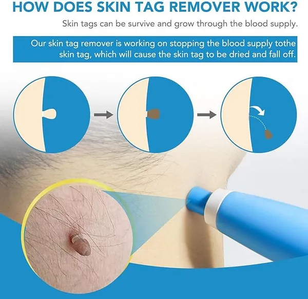 Blue_Medical-Grade_Abs_Plastic_Wand_And_Highly_Elastic_Silicone_Micro-Bands_Topical_Skin_Tag_Removal_Kit_For_Skin_Tag_Removal