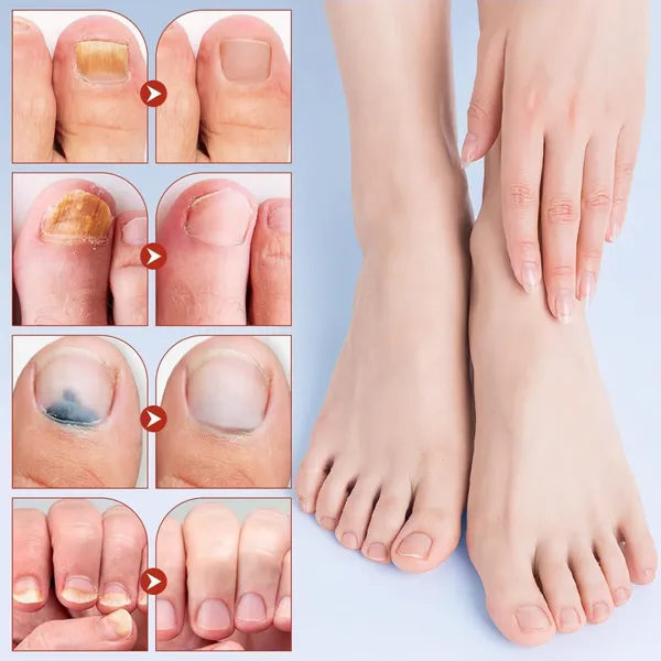 Brown_Adhesive_Hydrogel_Base_Infused_With_Active_Treatment_Polymers_Nail_Repair_Patches_For_Damaged,_Brittle,_Or_Discolored_Nails_Pack_Of_2