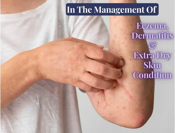 Koebner_Organic_Cream_for_ECZEMA_and_Extra_Dry_Skin,_100%_Natural,_Chemical_&_Preservative_Free,_Nourish_with_Vitamin_E_-_50gm