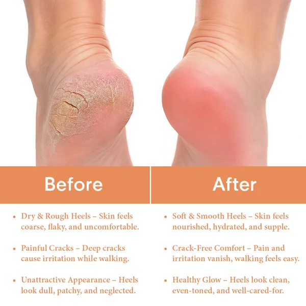 Anti_Crack_Foot_Cream