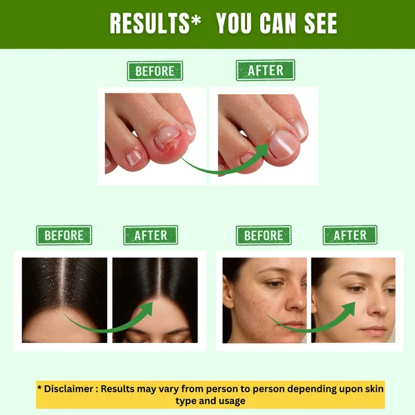 Tea-Tree-Teatree-Essential-Oil