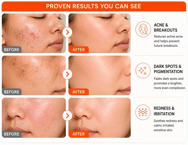 Skinoren_Azelaic_Acid_20%_Acne_&_Dark_Spot_Treatment_Cream