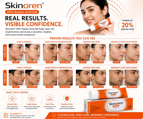 Skinoren_Azelaic_Acid_20%_Acne_&_Dark_Spot_Treatment_Cream