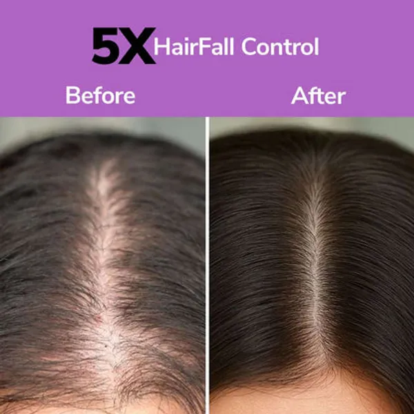 Freshluxe_Rice_Water_Onion_Rosemary_Hair_&_Face_Combo_Pack_Of_2