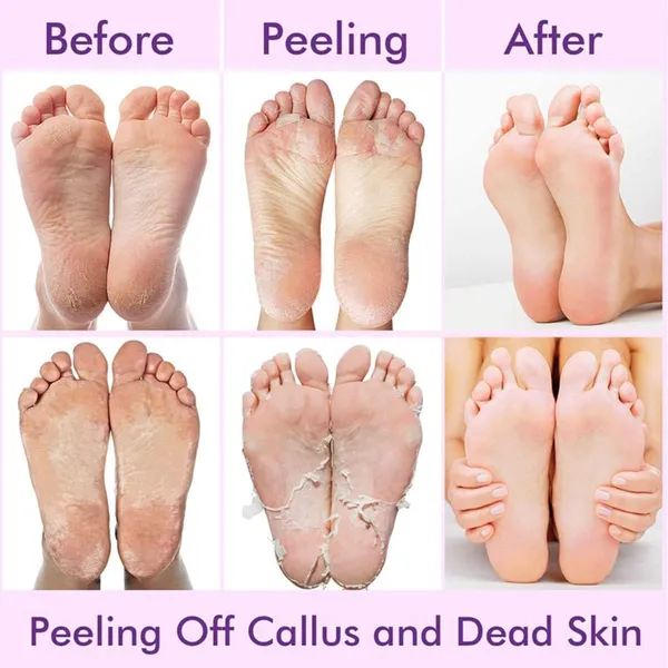 Feenec_Mart_Foot_Peel_Mask_1_Pack_Exfoliating_Foot_Mask_For_Dry_Cracked_Callused_Feet_Foot_Spa_Peeling_Mask_For_Men_Women_Dead_Skin_Heel_Repair_Treatment_Foot_Care_Moisturizer_Goat_Milk