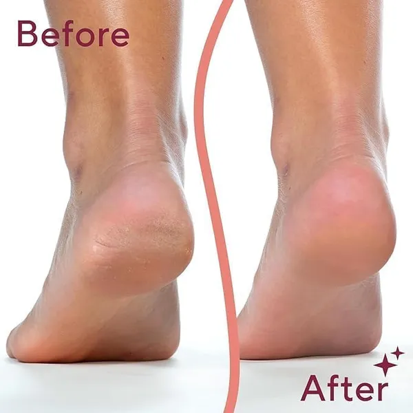 Callus_Remover_For_Feet_Dead_Skin_Remover_Pedicure_Tools_Callus_Remover_Hard_And_Dead_Skin_Remover_Electric_Foot_Callus_Remover_Rechargeable_Pedicure_Tool_Pink