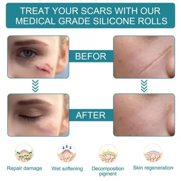 Silicone_Scar_Removal_Sheet