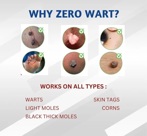 Zero_Wart_5ml_Effective_Wart_Remover_Solution_Pack_Of_2_Default_Title
