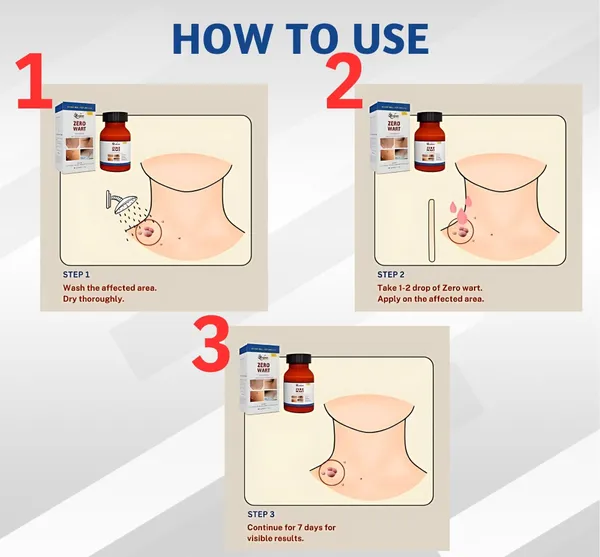 Zero_Wart_5ml_Effective_Wart_Remover_Solution_Pack_Of_2_Default_Title