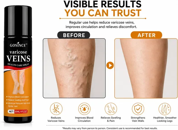 Gosince_Leg_Vein_Care_Spray_for_Varicose_&_Spider_Veins|_Pain_Relief,_Swelling_Reduction_Spray_(3_x_10_ml)