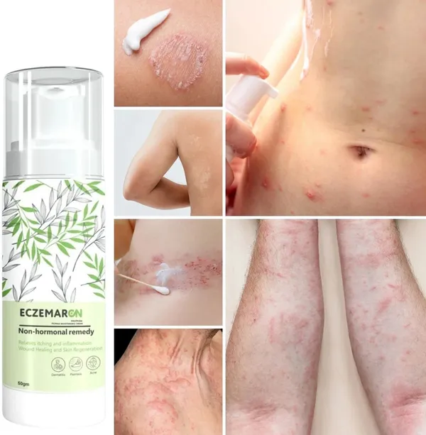 Gosince_Eczemaron_Psoriasis_&_Eczema_Relief_Spray_|_Steroid_Free_|_Fast_Soothing_Skin_Repair_(50_g)