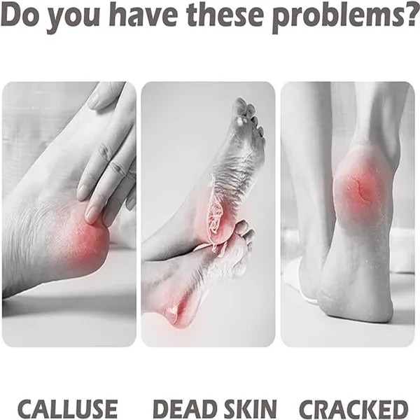Foot_File_Callus_Remover