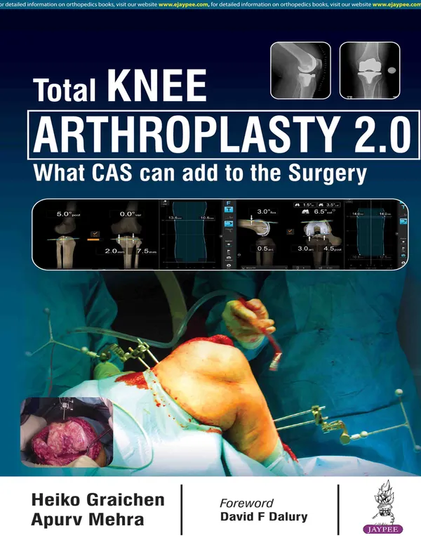 Total_Knee_Arthroplasty_2_0_What_Cas_Can_Add_To_The_Surgery