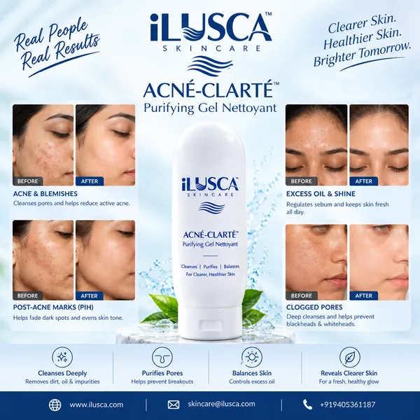 Anti-acne-cream