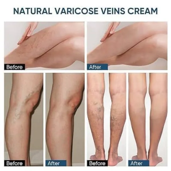 Varicose_Veins_Health_Care_Paste_Pack_Of_10