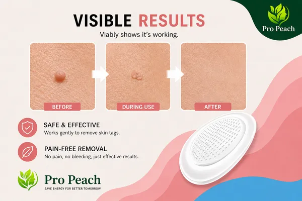 Pro_Peach_Skin_Tag_Remover_Tool