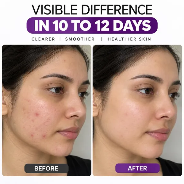 Acne_Treatment_Face_Serum