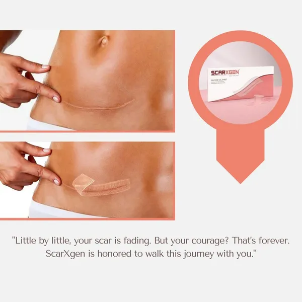 Scarxgen_C-Section_Scar_Strips__3cm_x_15cm