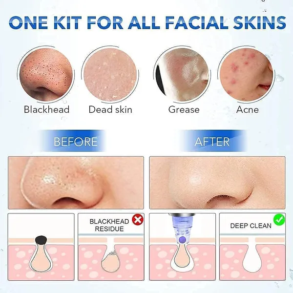 Derma_Suction_Multi_Function_Whitehead___Blackhead_Remover_Tool